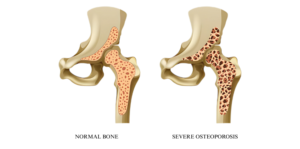 Osteoporosis & Bone Density Disorder Treatment in India