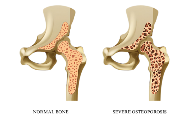 Osteoporosis & Bone Density Disorder Treatment in India