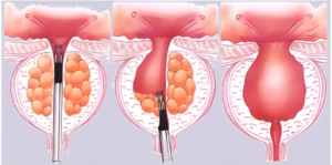 Benign Prostatic Hyperplasia (BPH) Treatment in India
