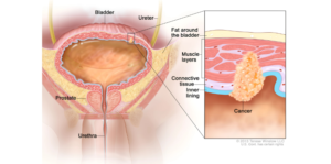 Bladder Cancer Treatment in India