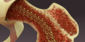 Bone Marrow Transplant Treatment in India