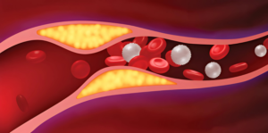 Coronary Artery Disease (CAD) Treatment in India