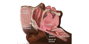 Sleep Apnea Treatment in India
