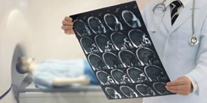 Brain Stroke Treatment in India