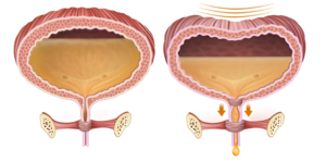 Urinary Incontinence Treatment in India